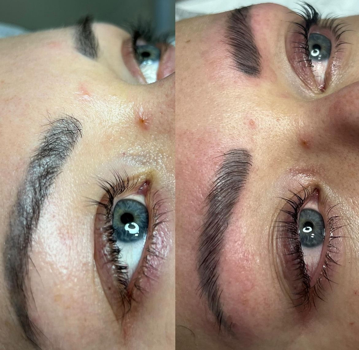 browlifting
