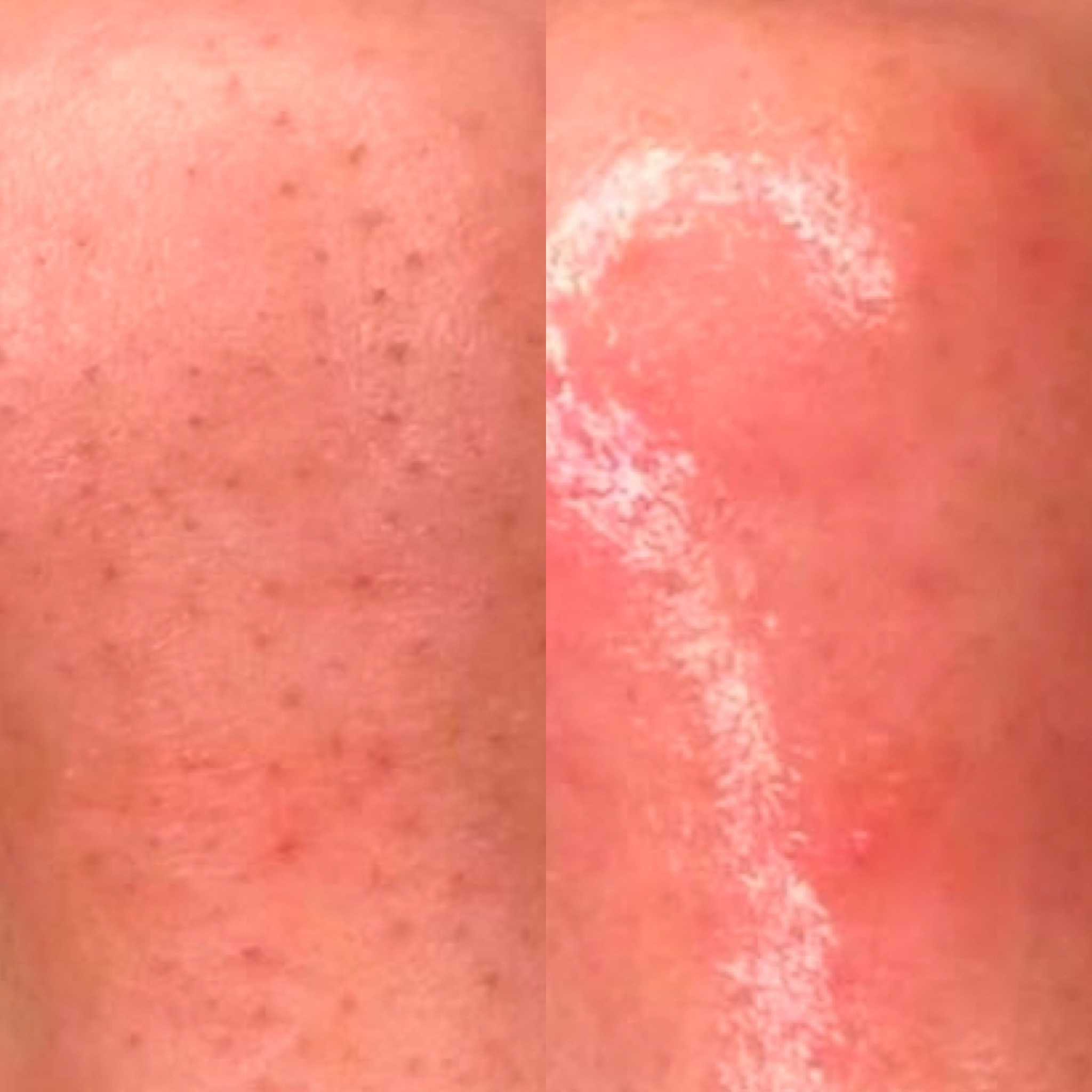 Microdermabrasion Schulung
