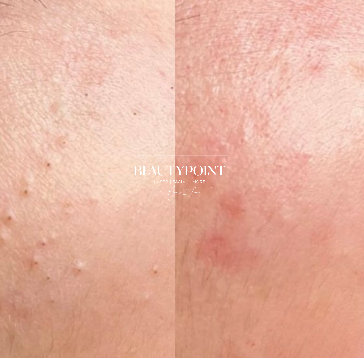 microneedling